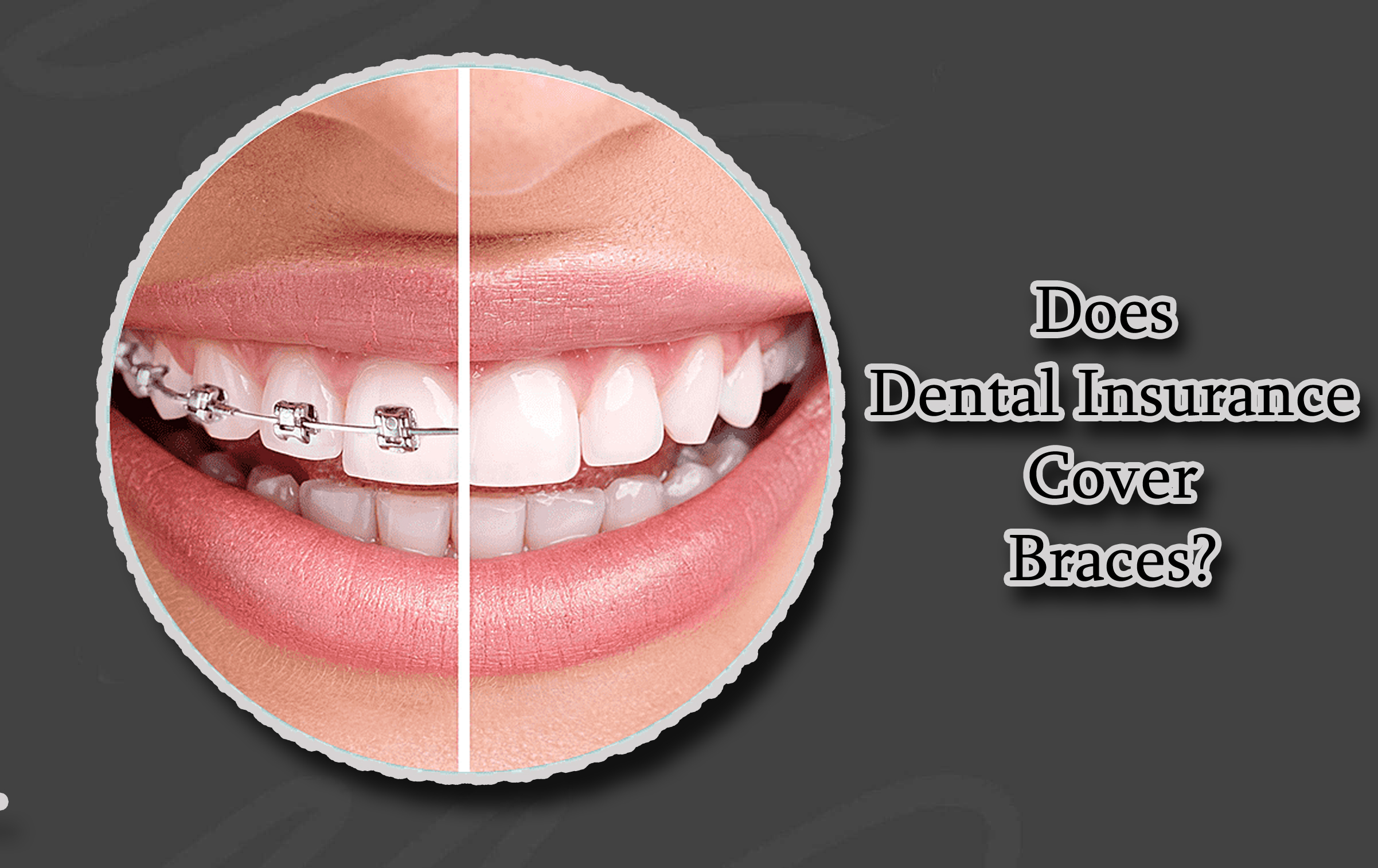 Does Dental Insurance Cover Braces?