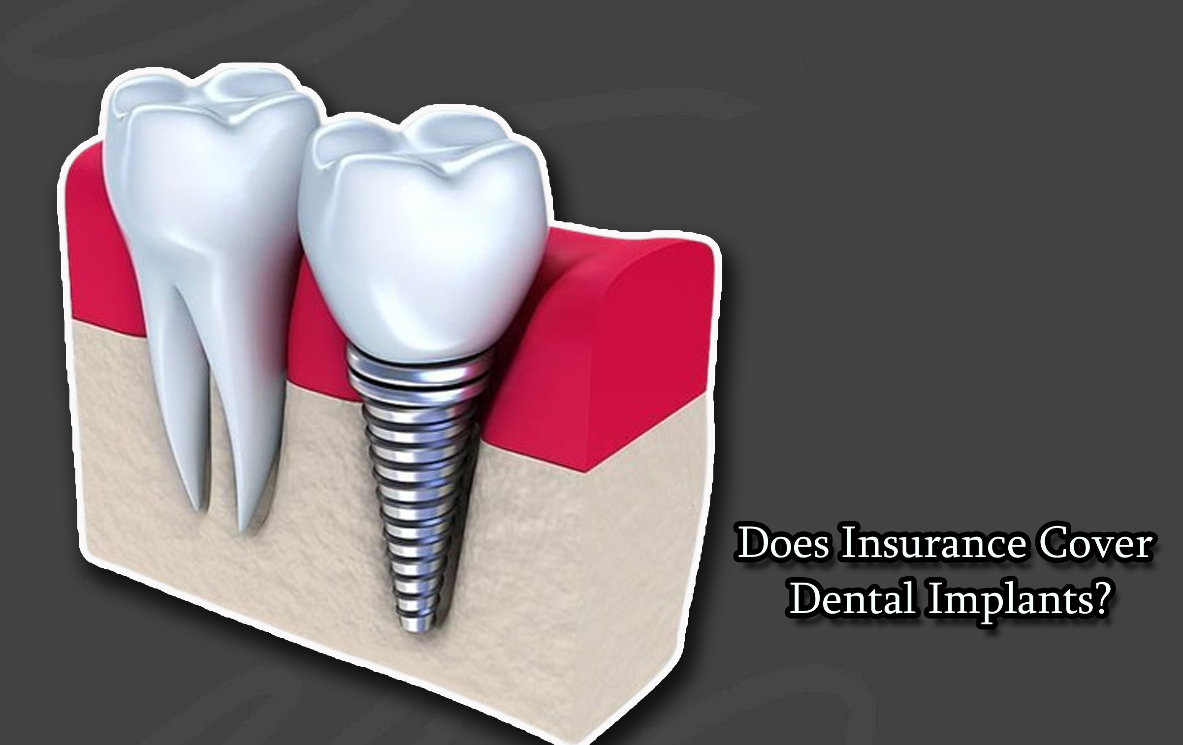 Does Insurance Cover Dental Implants?